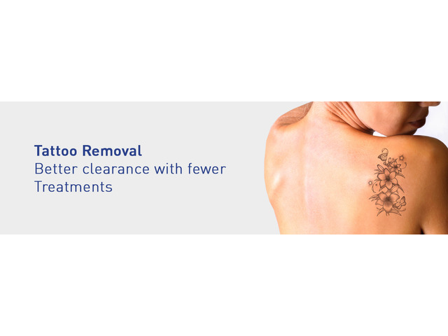 Permanent Tattoo Removal Tattoo Removal In Coimbatore  View Cost Book  Appointment Online  Practo