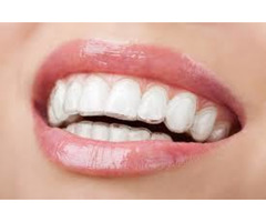 Teeth Straightening Aligners, Clear Teeth Straighteners - Image 1/7