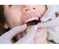 Teeth Straightening Aligners, Clear Teeth Straighteners - Image 3/7