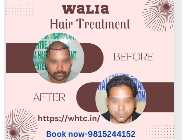 Ask Me Style Hair Transplant Clinic  Best Hair Transplant Clinic in Punjab