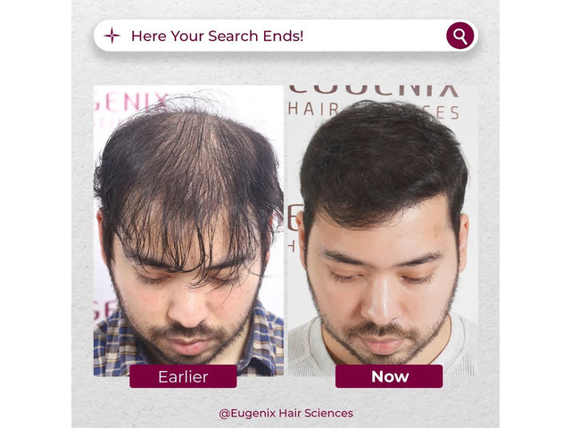 Best Hair Transplant Clinic in India Gurgaon - Buy Sell Used Products  Online India 