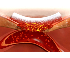 Absorbable Hemostatic Sponge - Image 1/2