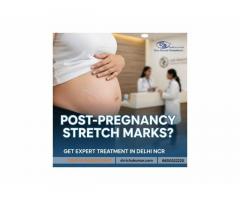 Post-Pregnancy Stretch Marks? Get Expert Treatment in Delhi NCR - 1