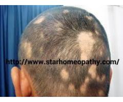 Homeopathic Doctors For Alopecia , Homeopathy Treatment For Alopecia - Image 3/3