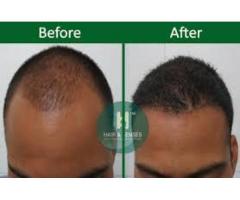 Hair Transplant in India - Image 1/4