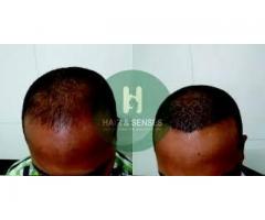 Hair Transplant in India - Image 3/4