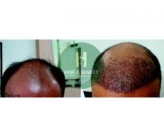 Hair Transplant in India - Image 4/4